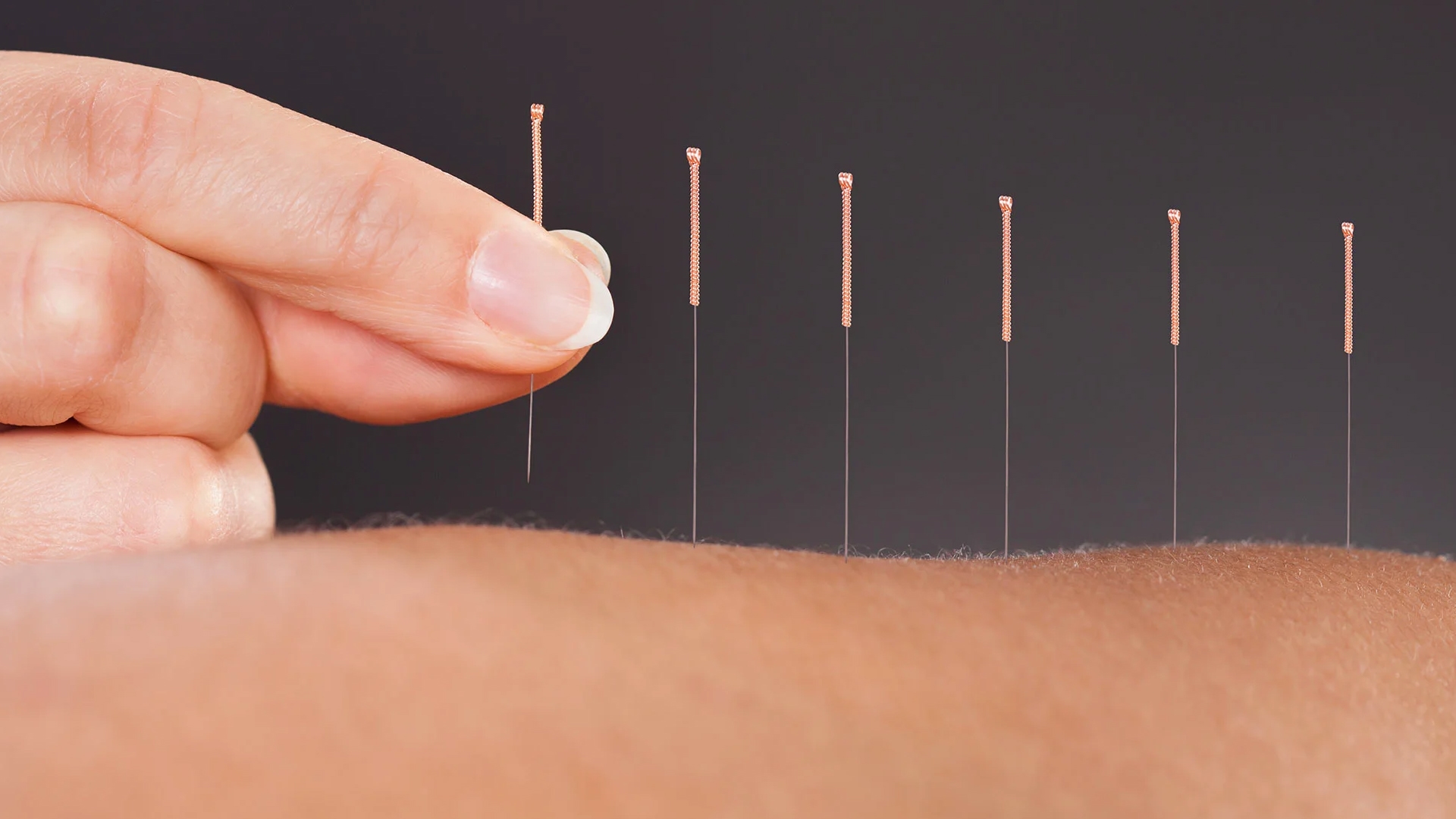 Aspecte esentiale ale acupuncturii