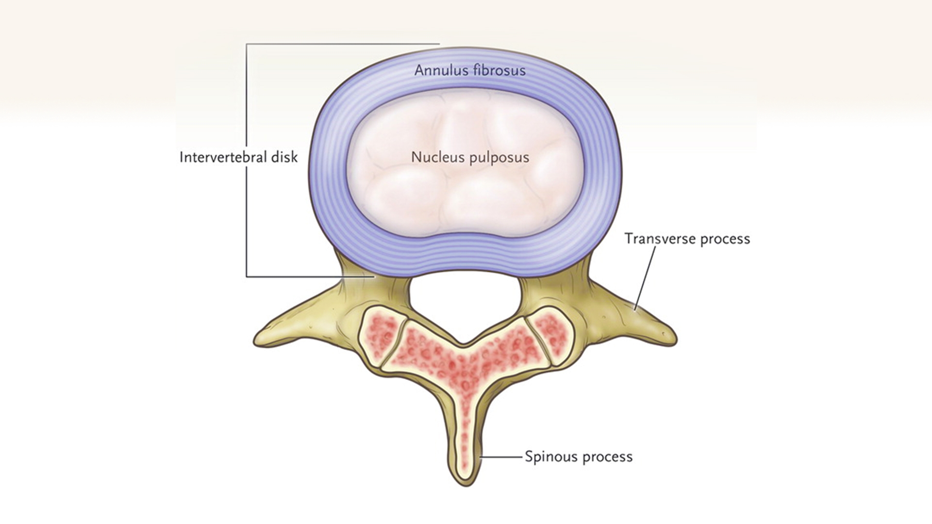 Discul intervertebral