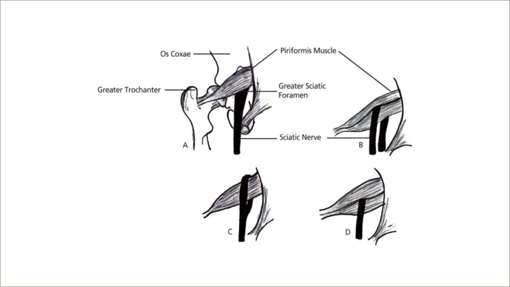 Lombosciatica sau durerea lombara