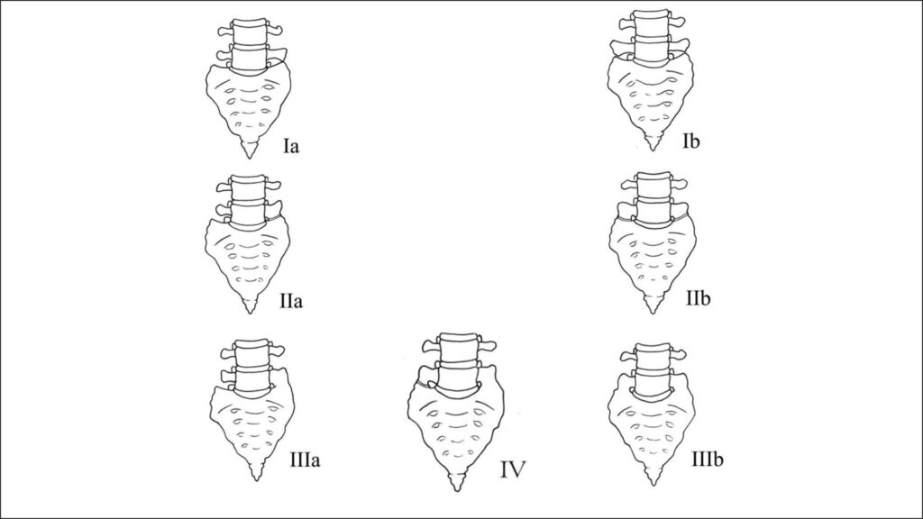 Sacralizarea vertebrelor