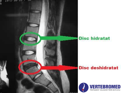 Hidratarea discului intervertebral