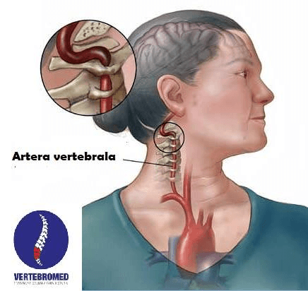 Sindromul arterei vertebrale