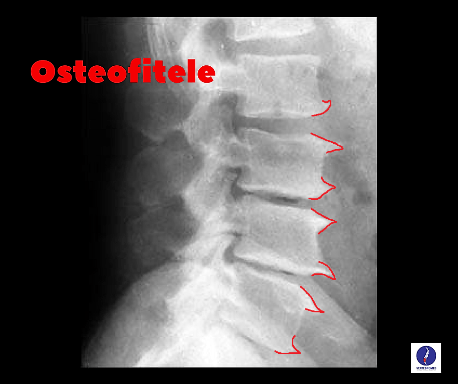 Osteofitele