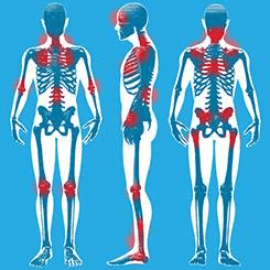 Fibromialgia